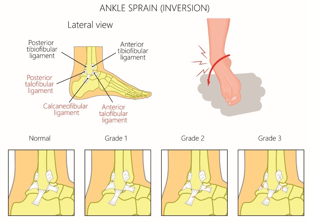 ankle sprain inversion